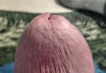 Bulging